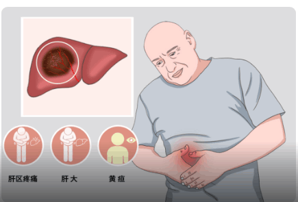 肝癌的中期症状