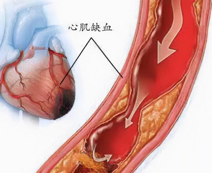 心肌缺血有什么症状和表现